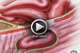 HERNIA REPAIR INGUINAL MEDICAL ANIMATION VIDEO