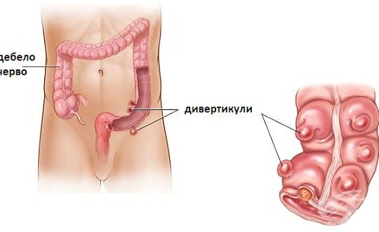 ДИВЕРТИКУЛОЗА НА ДЕБЕЛОТО ЧЕРВО