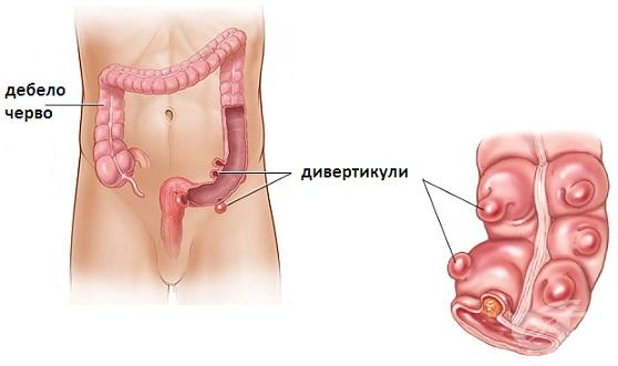 ДИВЕРТИКУЛОЗА НА ДЕБЕЛОТО ЧЕРВО