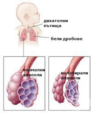 Ателектаза