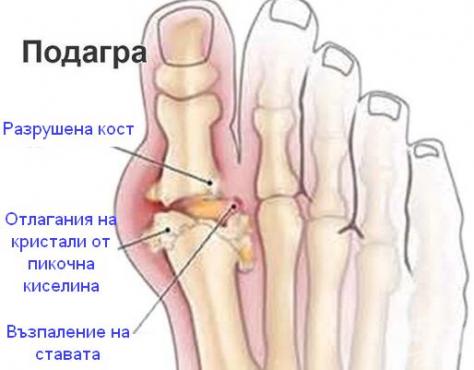 Подагра