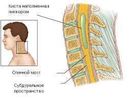 Сирингомиелия